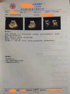 ​体检前列腺有钙化点是怎么回事 体检说前列腺钙化是什么意思