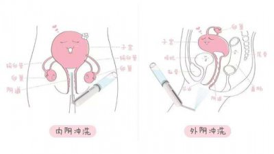 ​念珠菌阳性 什么是念珠菌性阴道炎？怎么知道自己有没有念珠菌性阴道炎？