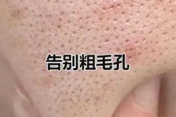 毛孔粗大怎么办怎么收缩毛孔 毛孔粗大用什么护肤品可以改善