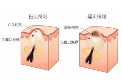 ​粉刺的正确处理方法 粉刺的白色东西是什么