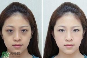 卧蚕是黑眼圈吗？卧蚕和黑眼圈的区别