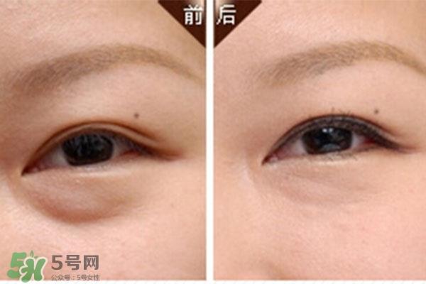 卧蚕是黑眼圈吗？卧蚕和黑眼圈的区别