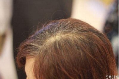 ​白头发是怎样引起的 怎样预防白头发