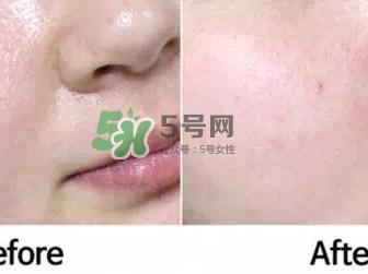 homefacialpro蜂胶面膜怎么样_hfp蜂胶面膜好用吗