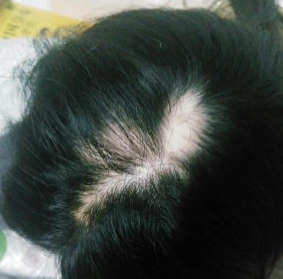 观察下自己的头，5种表现说明你头皮全是螨虫，简单3招可除干净!