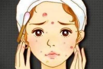 ​青春痘是皮肤病吗 青春痘要挤掉吗