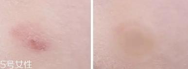 vt痘痘贴怎么用？vt老虎痘痘贴防水吗