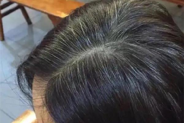白头发多是体内缺少什么元素 白头发补维生素b几