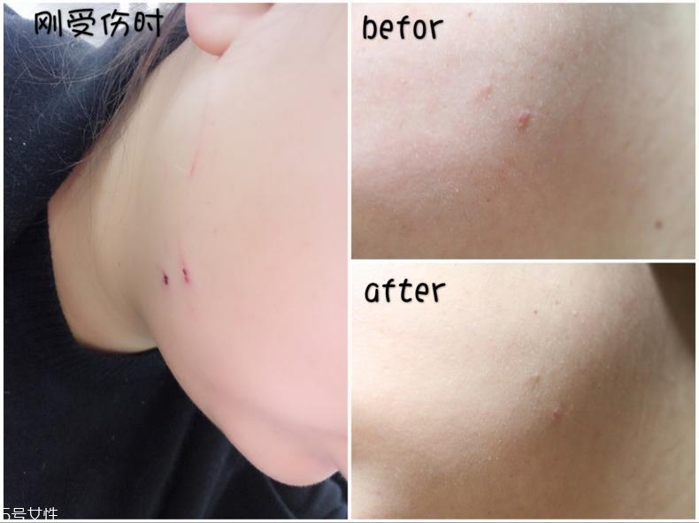 舒痕硅凝胶去疤有效吗 舒痕硅凝胶15g能用多久
