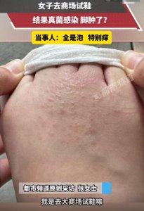 ​女子商场试鞋，回家后瘙痒难耐，一看密密麻麻全是泡！