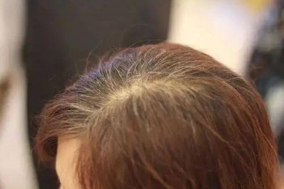 ​白头发染了会越来越多吗 白头发染黑能维持多久