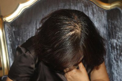 ​脱发是什么 成年人一天掉多少头发正常