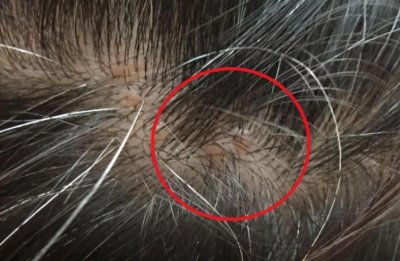 ​头皮上，长出来硬硬的小疙瘩是什么？很多人不清楚，麻烦正确对待